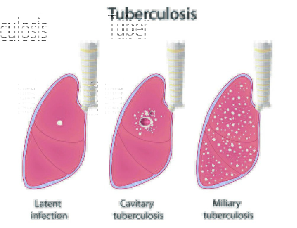 Tuberculosis Doctors